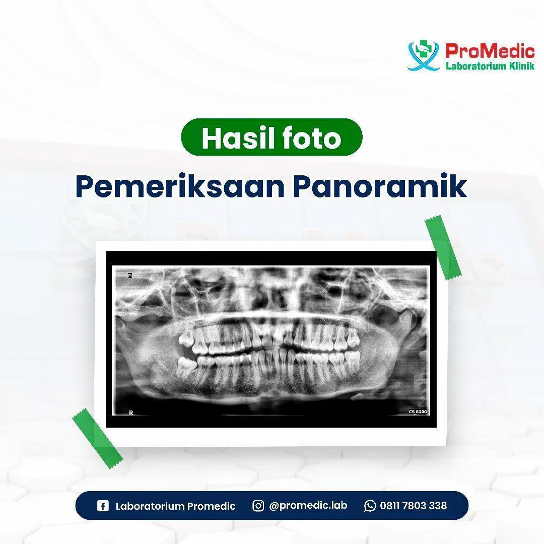 Kini rontgen gigi panoramic dan cephalometri  tersedia di laboratorium promedic